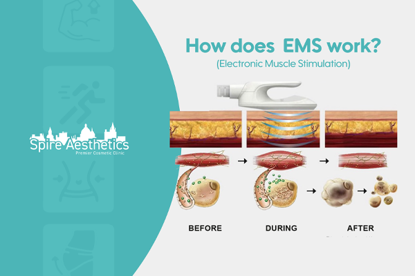 EMS treatment for post pregnancy weight loss treatment Solihull Lodge