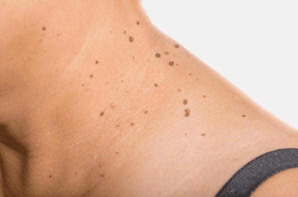 Are you looking for easy skin tag removal Solihull Lodge - then contact Spire today!