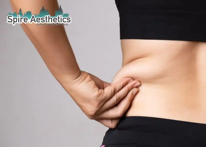 Image of woman pinching fat on their hips Solihull Lodge. Fat Freezing treatment