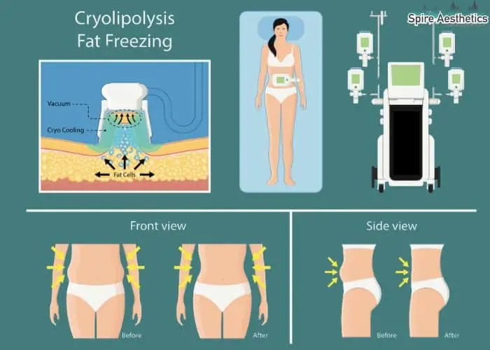 Fat freezing treatment Solihull Lodge benefits for competitions to remove stubborn fat deposits.